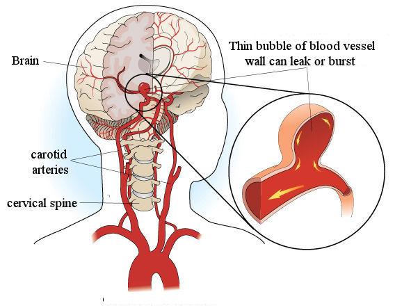 Прецеребральных артерий. Церебральные сосуды головного мозга что это. Аневризма головного мозга схема.
